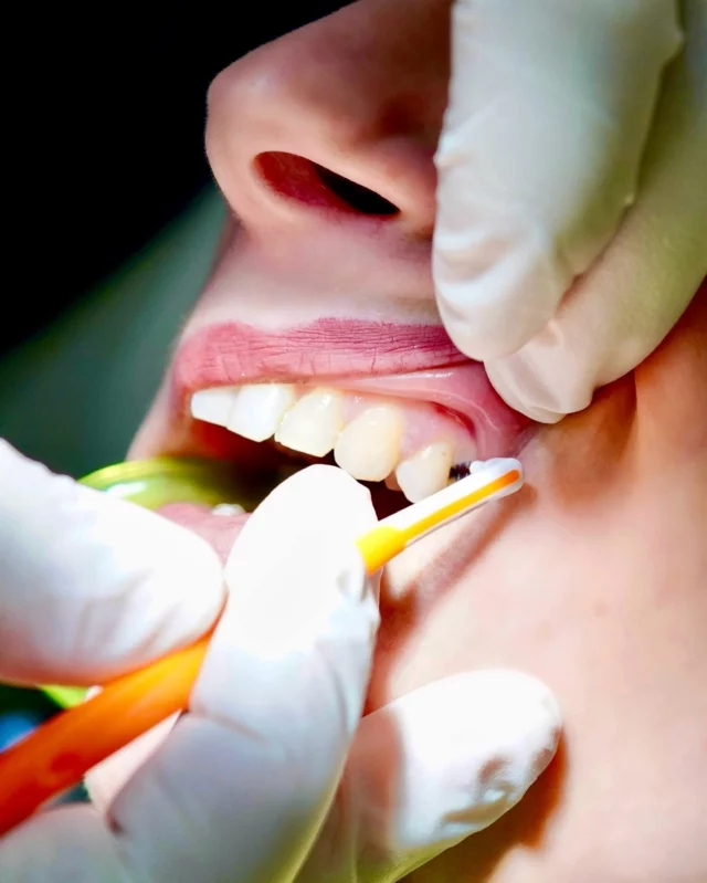 E tu, lo usi lo scovolino?
Se la risposta è no, è il momento di cambiare abitudini!

Lo scovolino interdentale arriva dove lo spazzolino si ferma: tra un dente e l’altro, dove si nascondono placca e residui. Usarlo ogni giorno aiuta a prevenire carie, gengiviti e alito cattivo.

Pochi secondi, massima pulizia!
Prenota il tuo trattamento di igiene dentale e ti aiuteremo a trovare quello giusto per te.

Prenota ora la tua consulenza!
Contattaci QUI 👇

📞 06.475.413.04 - 379.24.28.502
📧 info@dentalhubitalia.it
💻 dentalhubitalia.it
 
📍Via Lari 55 - Roma, Magliana
📍Piazza Poggio Moiano 2 - Rieti

#dentalhub #dentalhubitalia #dentalhubroma